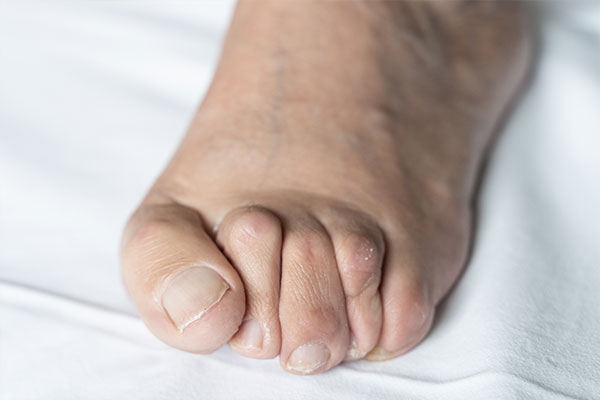 The image shows a person s foot with several toes visible, lying flat on what appears to be a white surface.